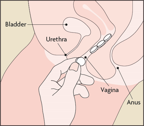 Misoprostol vajinal yerleştirme